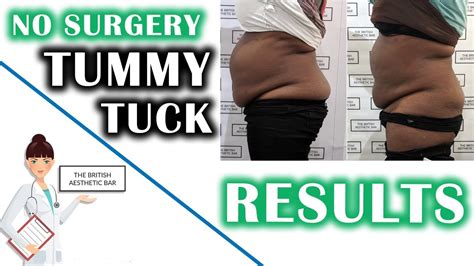 the stomach reduction surgery near me